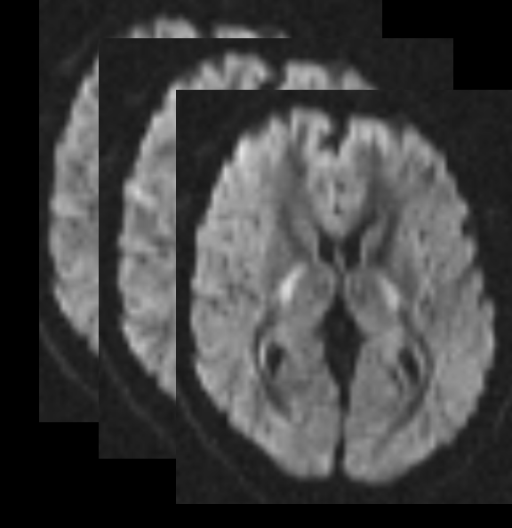 Diffusion Mri